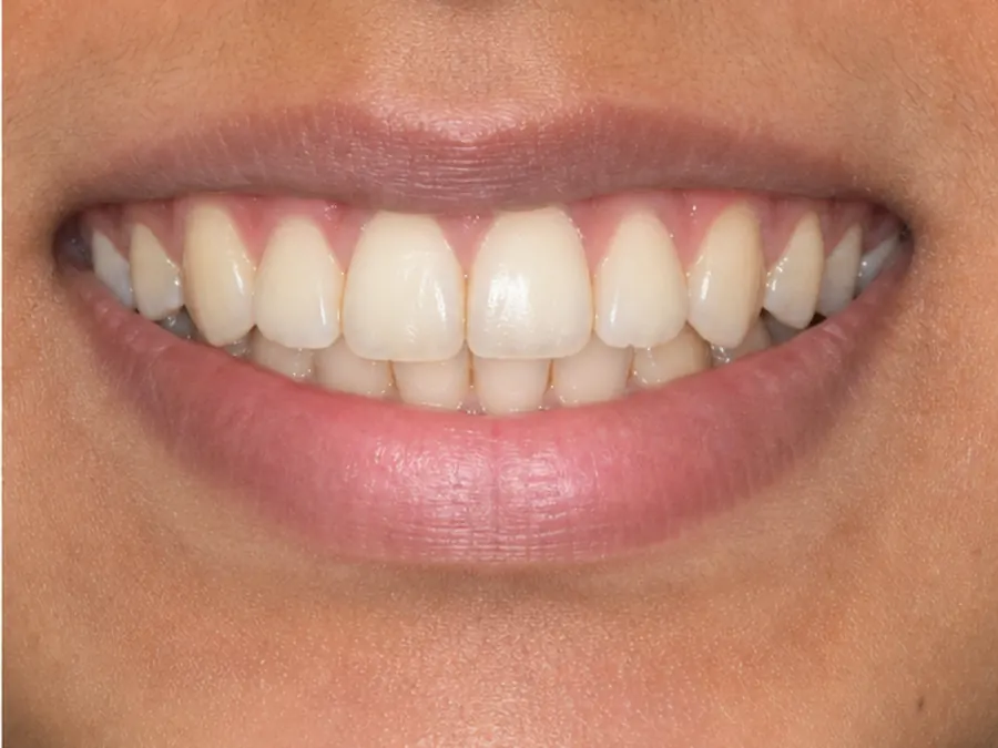 Clear Aligners after