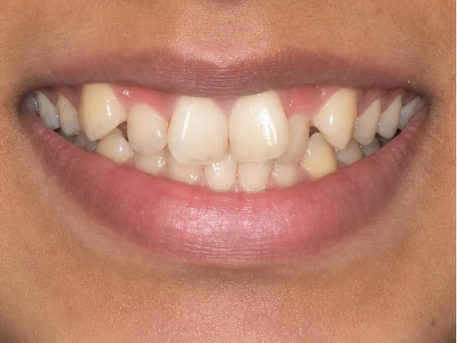 Clear Aligners before