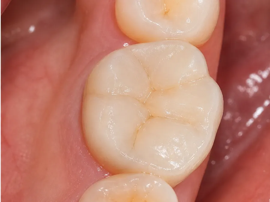 CEREC Crown after