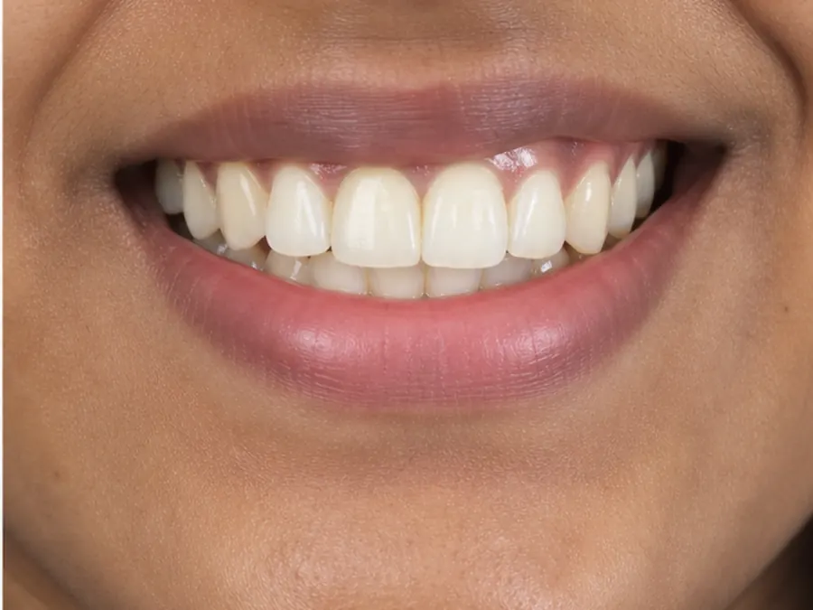 Dental Implant after
