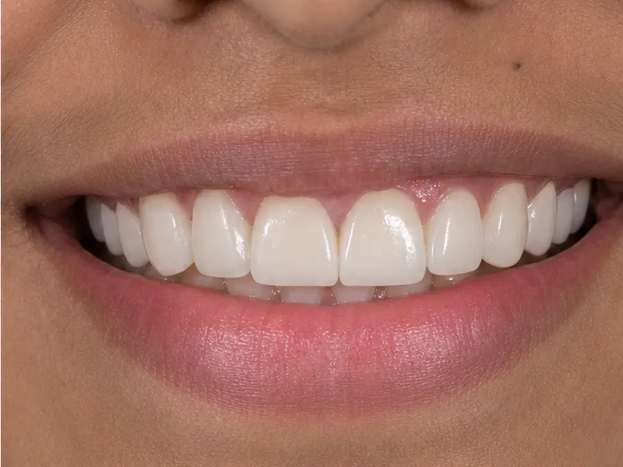 Smile Designing after
