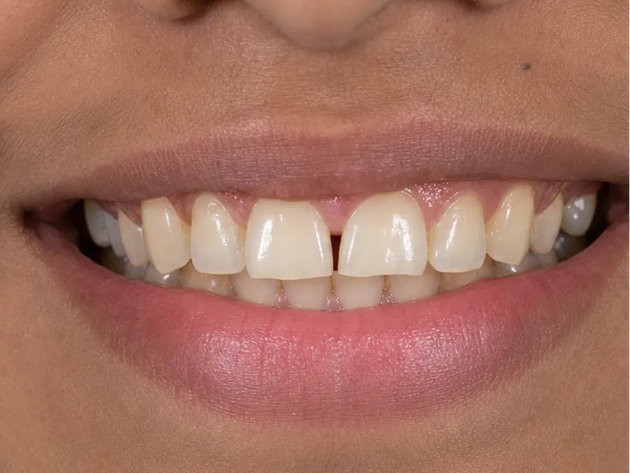 Smile Designing before