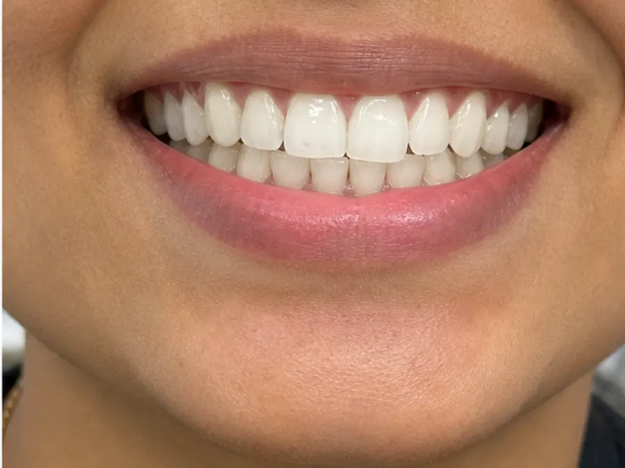 Teeth Whitening after