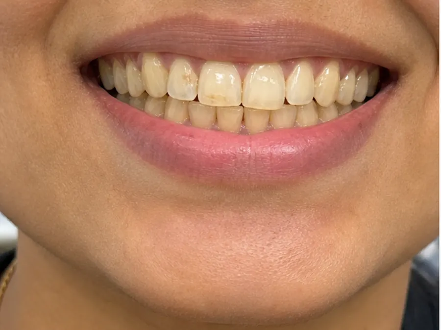 Teeth Whitening before